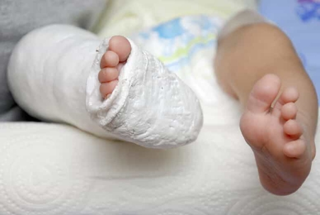 baby with a leg cast